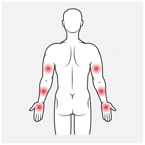 Ergonomie armklachten polsklachten